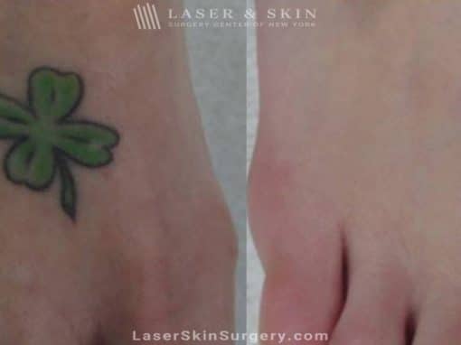 Laser Treatment for An Unwanted Green and Black Tattoo On the Foot