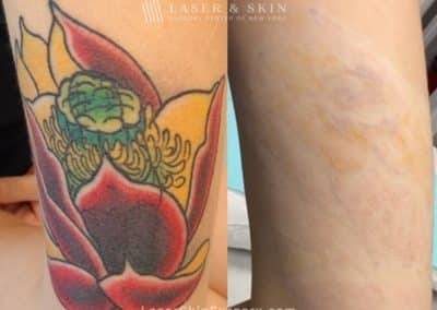 Lasers used to remove multi-colored tattoo from patient’s leg