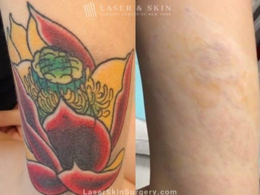 Lasers used to remove multi-colored tattoo from patient’s leg