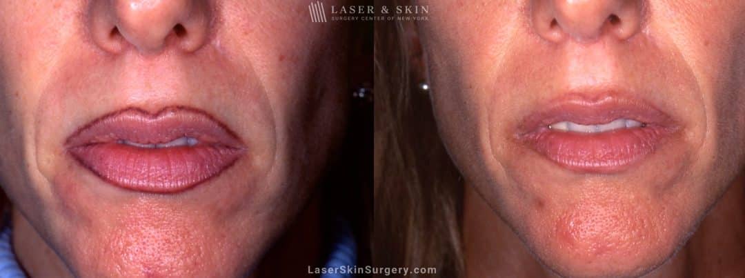 before and after image of lip liner tattoo removal