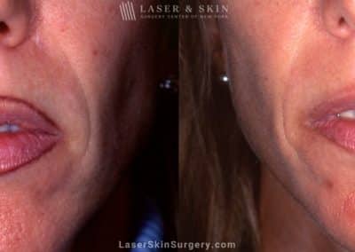 Laser Treatment For Tattoo Removal of Lip Liner