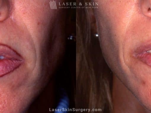 Laser Treatment For Tattoo Removal of Lip Liner