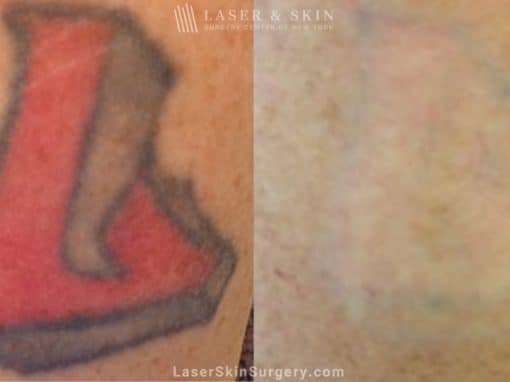 Laser Treatment For the Removal of a Red Colored Tattoo