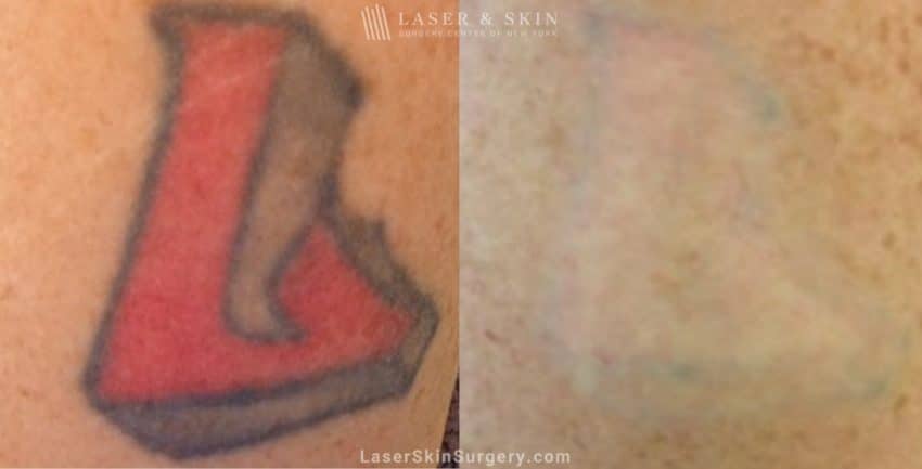 before and after treatment of a red black and gray tattoo on the arm