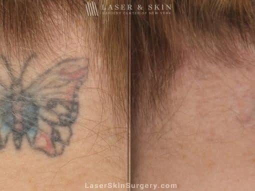 Laser Treatment For Tattoo Removal