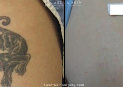Laser Treatment For Tattoo Removal