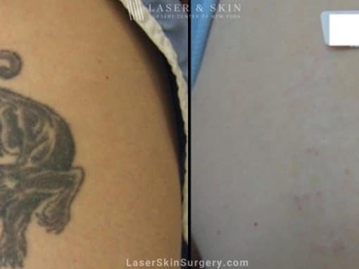 Laser Treatment For Tattoo Removal