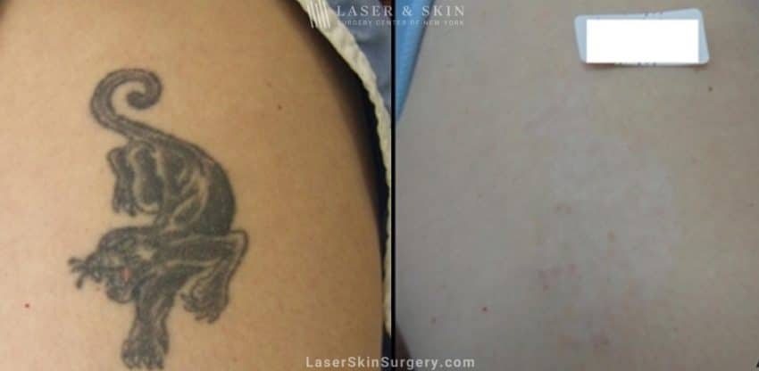 before and after laser treatment for tattoo removal black and white in color on the arm