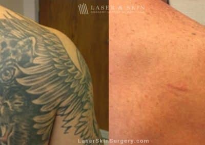 Lasers used to remove tattoo from patient’s shoulder