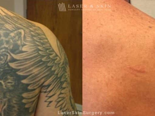 Lasers used to remove tattoo from patient’s shoulder