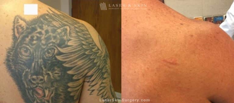 Lasers used to remove tattoo from patient’s shoulder