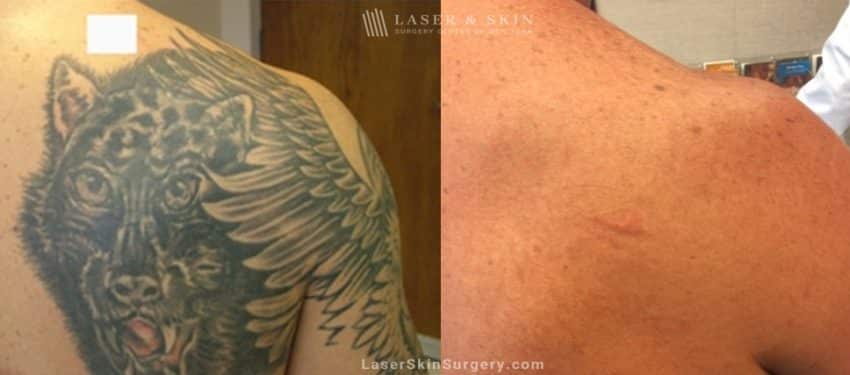 before and after laser treatment for tattoo removal on the upper back