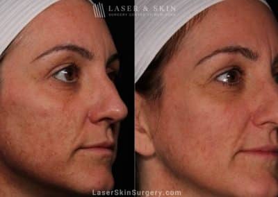 Laser Treatment for Melasma on the Face