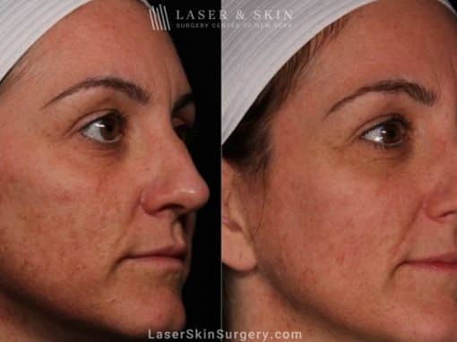 Laser Treatment for Melasma on the Face