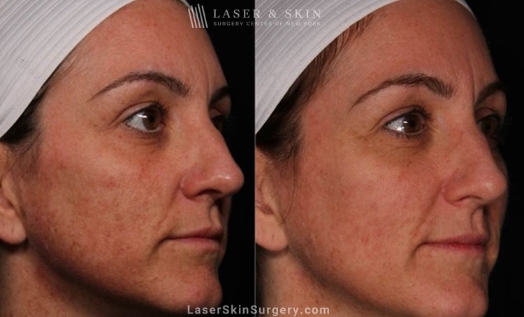 before and after image of a laser treatment for unwanted skin pigmentation also known as melasma on a woman's face