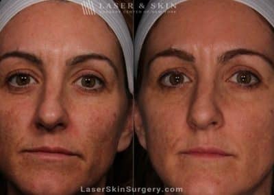 Laser Treatment for Melasma on the Face