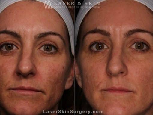 Laser Treatment for Melasma on the Face