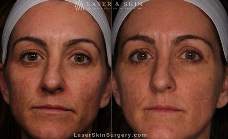 before and after image of a laser treatment for unwanted skin pigmentation also known as melasma on a woman's face