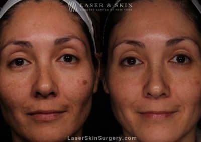 Laser Treatment for Melasma on the Face