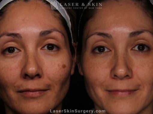 Laser Treatment for Melasma on the Face