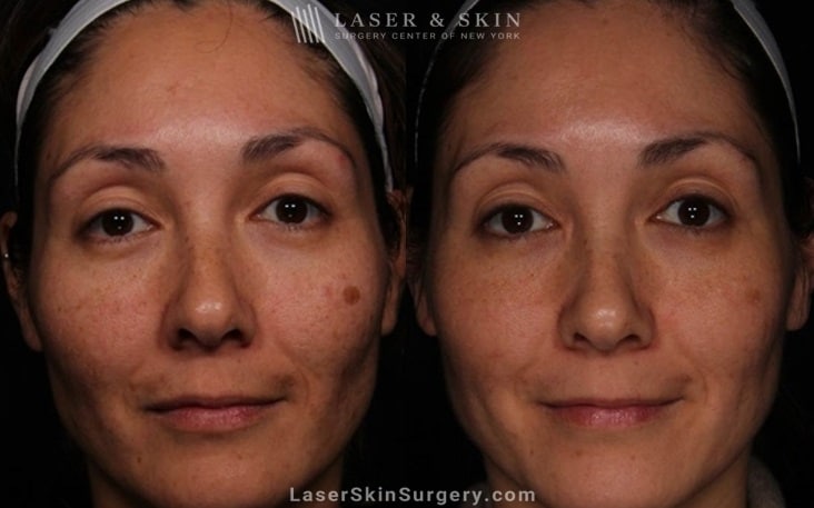 before and after image of a laser treatment for unwanted skin pigmentation also known as melasma on a woman's face