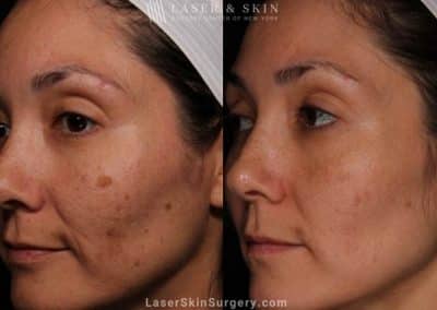 Laser treatment to reduce brown spots from melasma