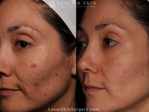 Laser treatment to reduce brown spots from melasma