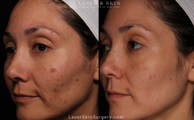 Laser treatment to reduce brown spots from melasma