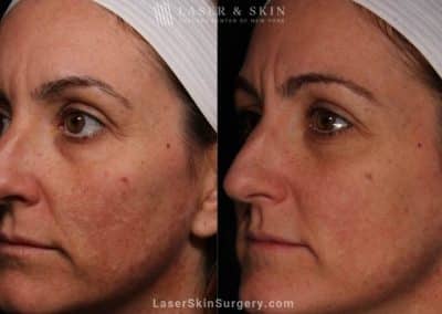 Laser Treatment for Melasma on the Face