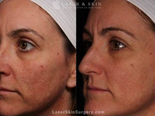 Laser Treatment for Melasma on the Face