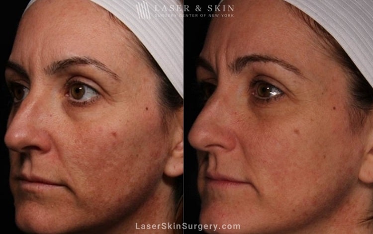 before and after image of a laser treatment for unwanted skin pigmentation also known as melasma on a woman's face