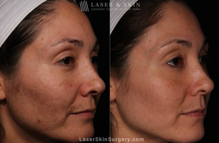 before and after image of a laser treatment for unwanted skin pigmentation also known as melasma on a woman's face