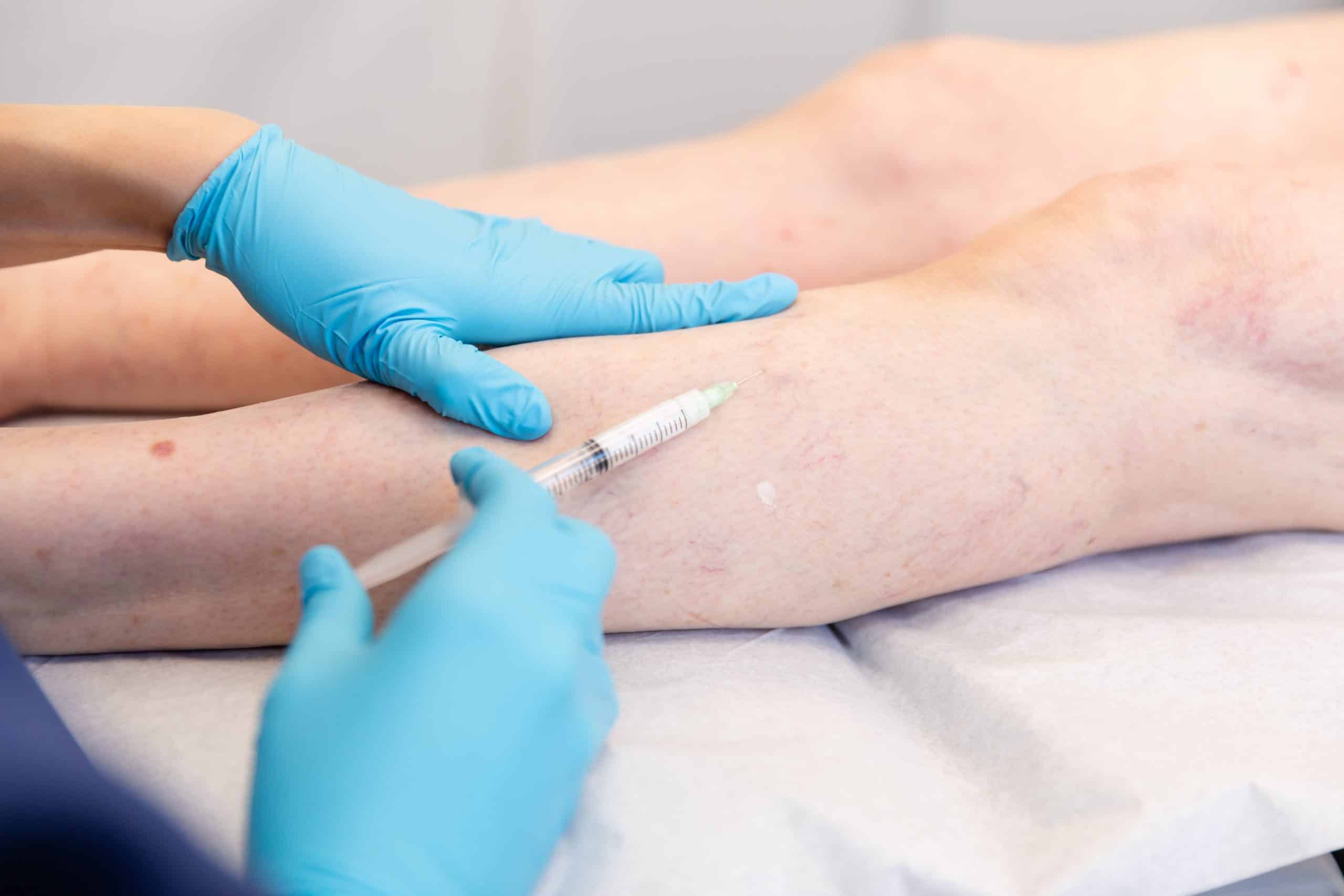 sclerotherapy varicose vein treatment in nyc