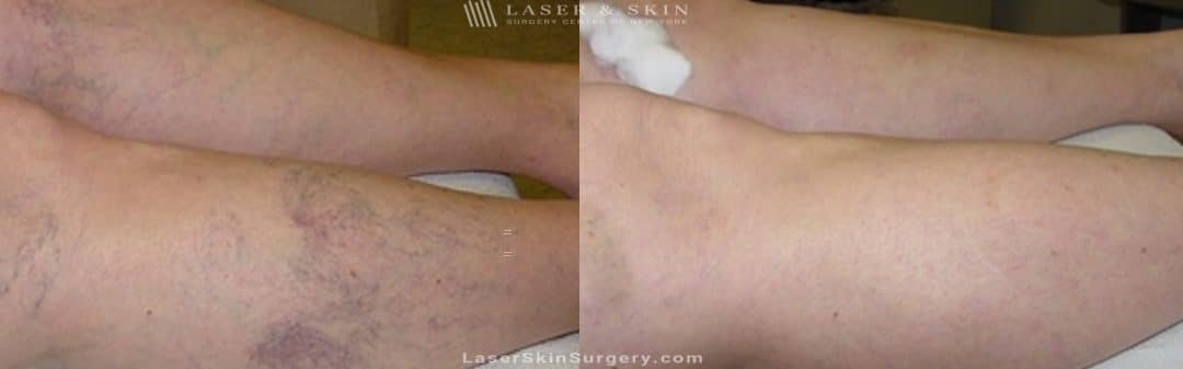 before and after image of a Sclerotherapy Injections for the Treatment of Spider Veins on the legs