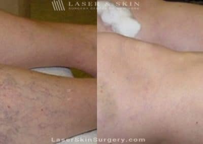 Sclerotherapy Injections for the Treatment of Spider Veins