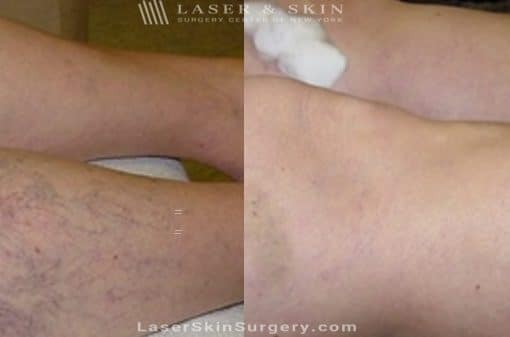 Sclerotherapy Injections for the Treatment of Spider Veins