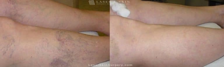 Sclerotherapy Injections for the Treatment of Spider Veins