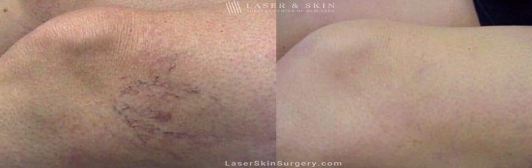 before and after image of a Sclerotherapy Injections for the Treatment of Leg Veins