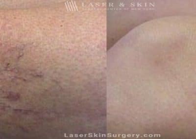 Sclerotherapy Injections for the Treatment of Leg Veins