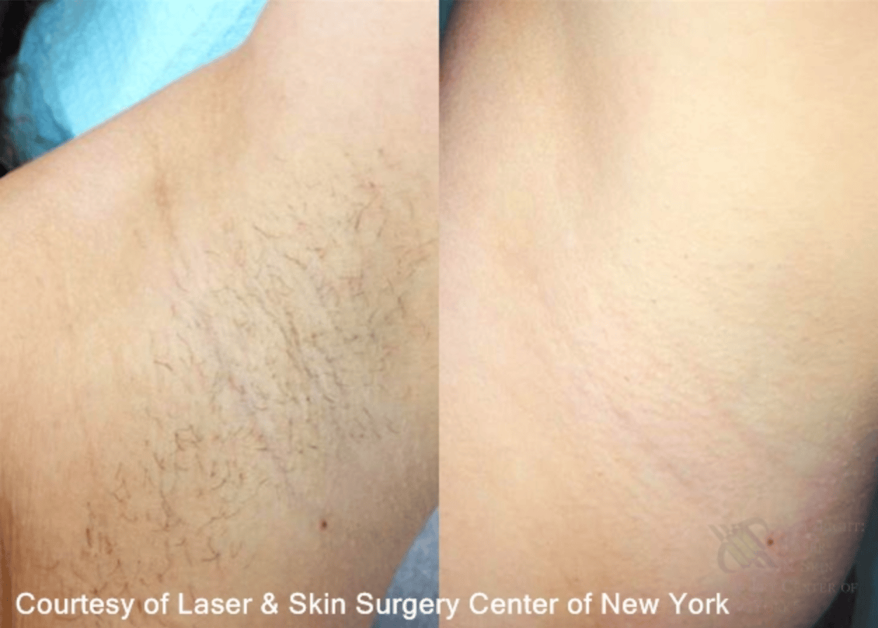 lsscny laser hair removal armpit before and after new york ny