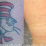 Picosecond Laser Shows Promise for New Era in Tattoo Removal