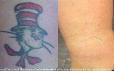 Picosecond Laser Shows Promise for New Era in Tattoo Removal