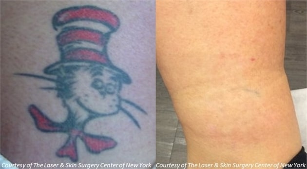 laser tattoo removal picosure in new york