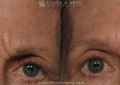 Botox Injections for the Forehead