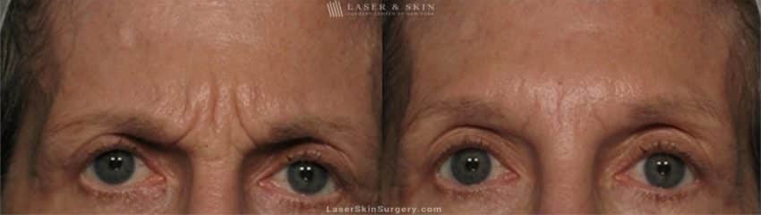 botox-injection-facial-wrinkles-men-3659 before and after image of a botox injection in a mans forehead to reduce the appearance of wrinkles