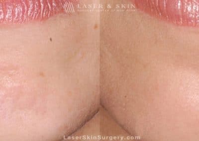 Botox Injections For Facial Wrinkles (Chin)