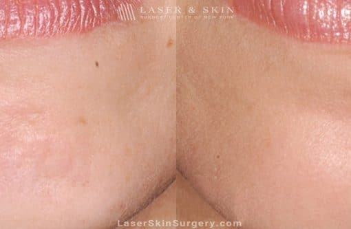 Botox Injections For Facial Wrinkles (Chin)