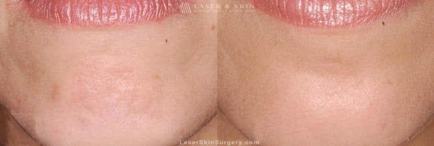 before and after image of a botox treatment in the chin area of a woman