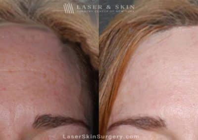 Botox Injections for Forehead Wrinkles
