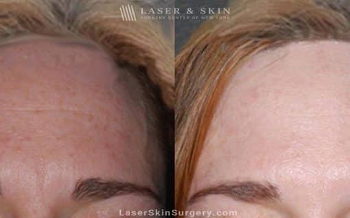 Botox Injections for Forehead Wrinkles